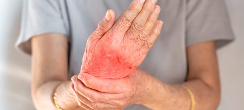 Hand joints inflammation. Concept and idea of rheumatic arthritis, rheumatism, gout, joint swelling or arthralgia.